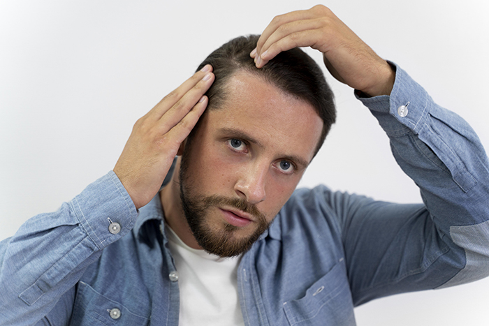 Alopecia masculina